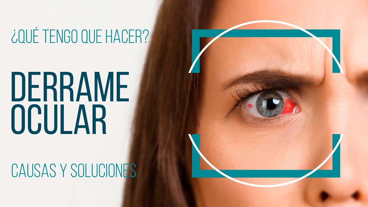 a que se debe un derrame en el ojo izquierdo