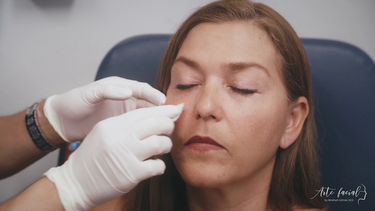 acido hialuronico bolsas ojos