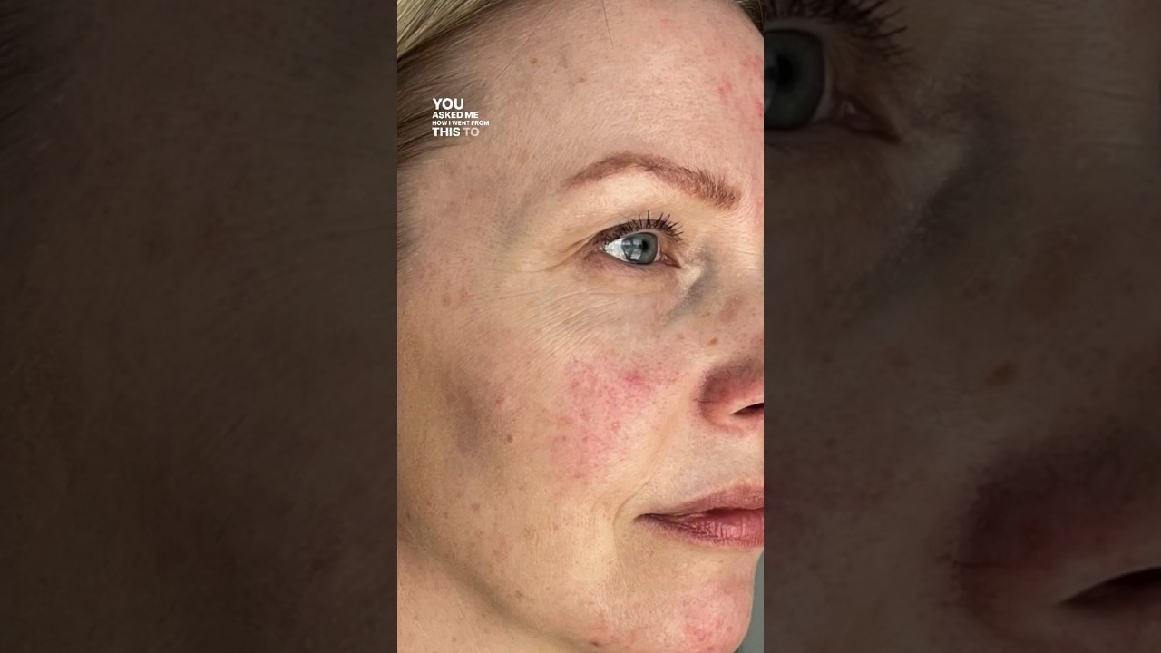 crema calmante rosacea