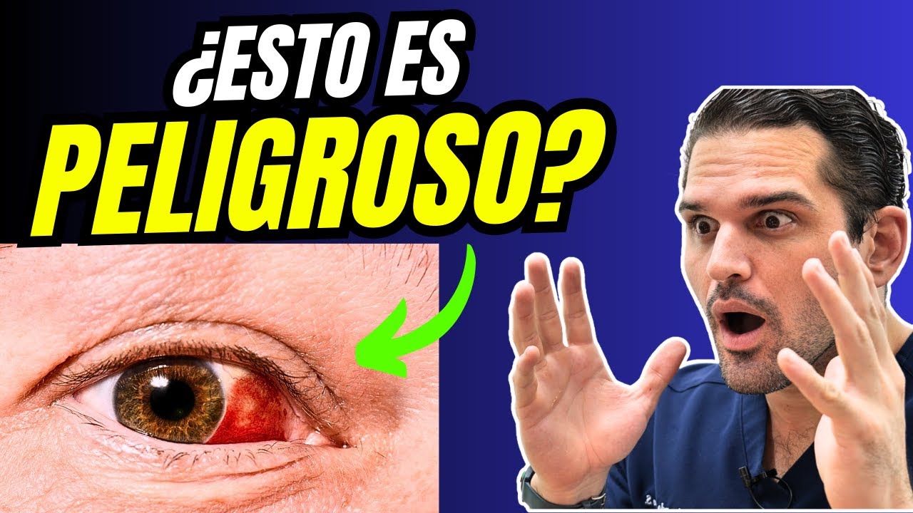 derrame en el ojo por tension alta