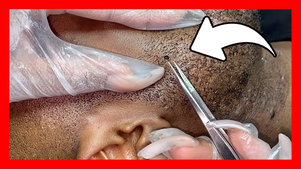 pelos enquistados vulva