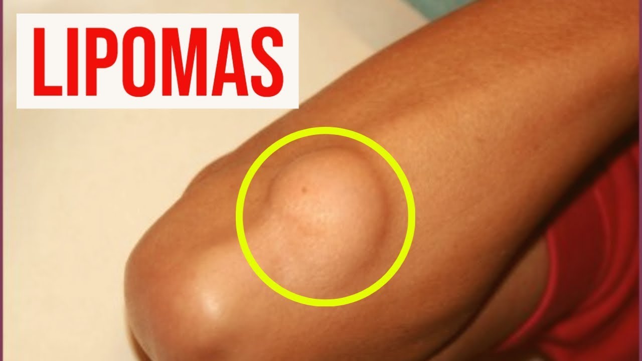 eliminar lipomas con calor