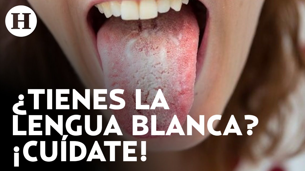 manchas blancas debajo de la lengua
