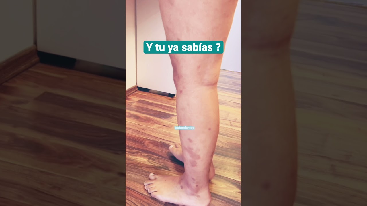 manchas en la piel marrones en las piernas