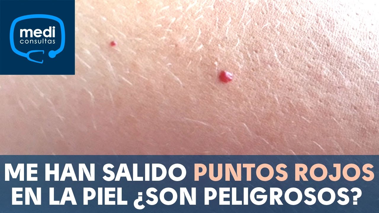 paladar con puntos rojos