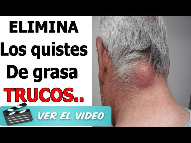 quiste sebaceo quitar en casa