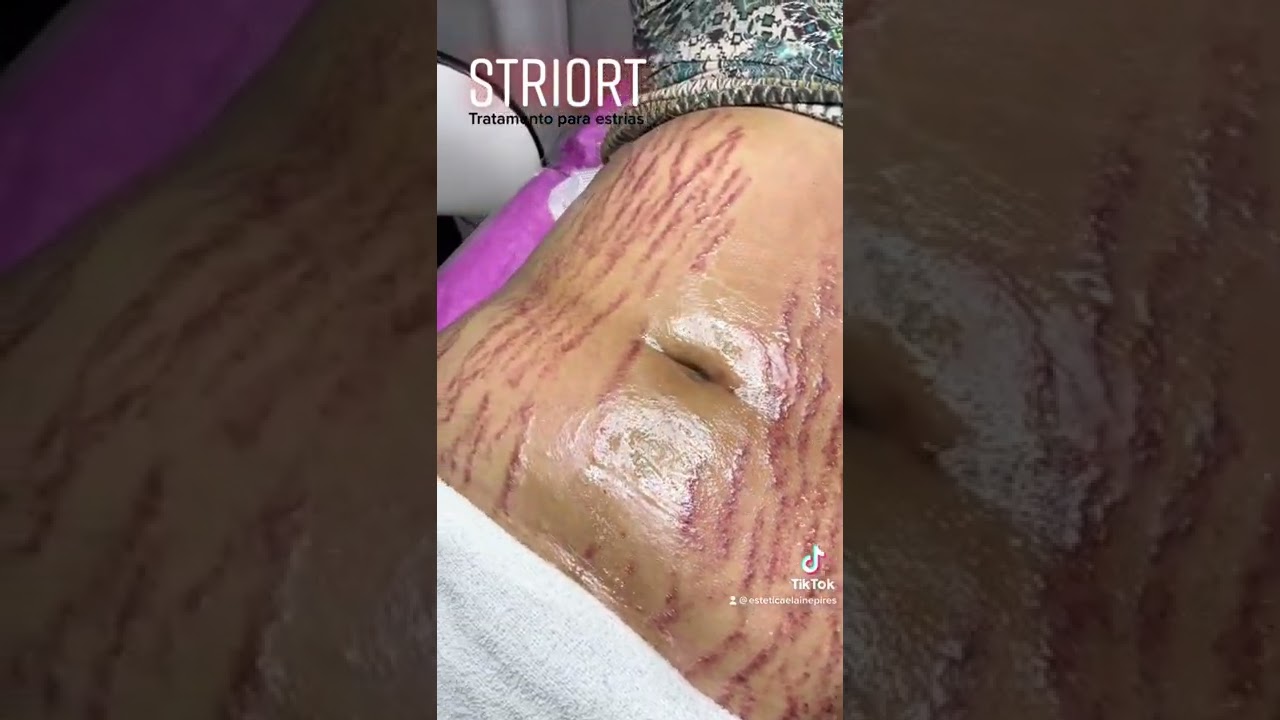 skinlabo estrias
