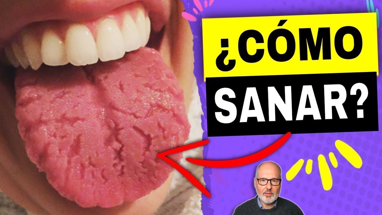 agua oxigenada para lengua agrietada