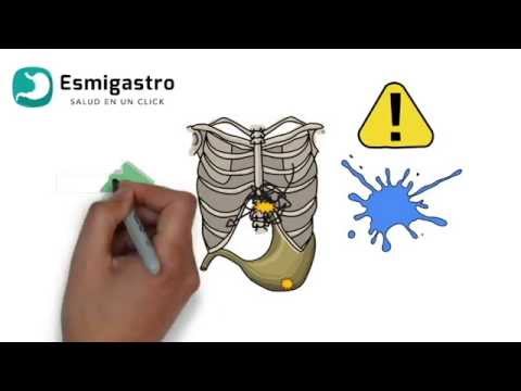 hernia de hiato bulto esternón
