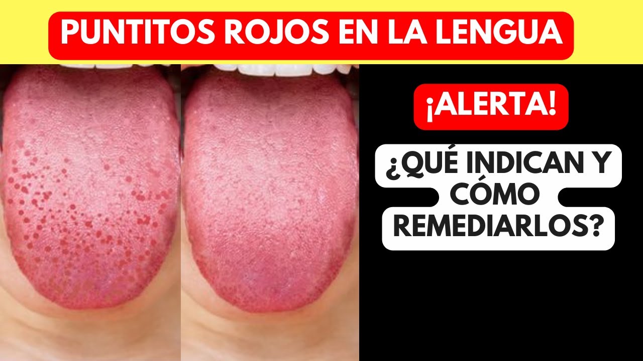 lengua puntos rojos