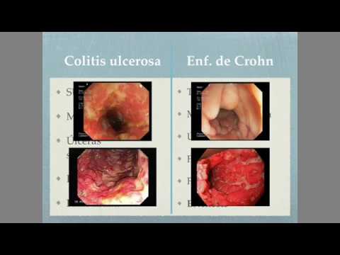 que es peor crohn o colitis ulcerosa
