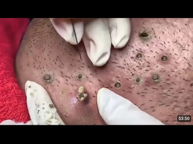 espinillas en la nariz