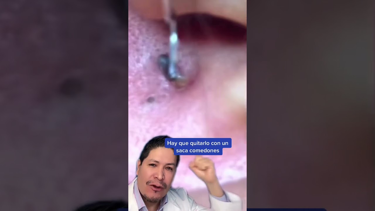 grano en el cartílago de la oreja
