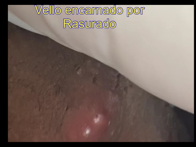 pelos encarnados pubis