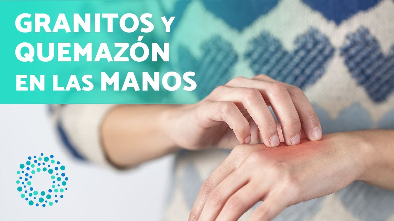 picor de mano